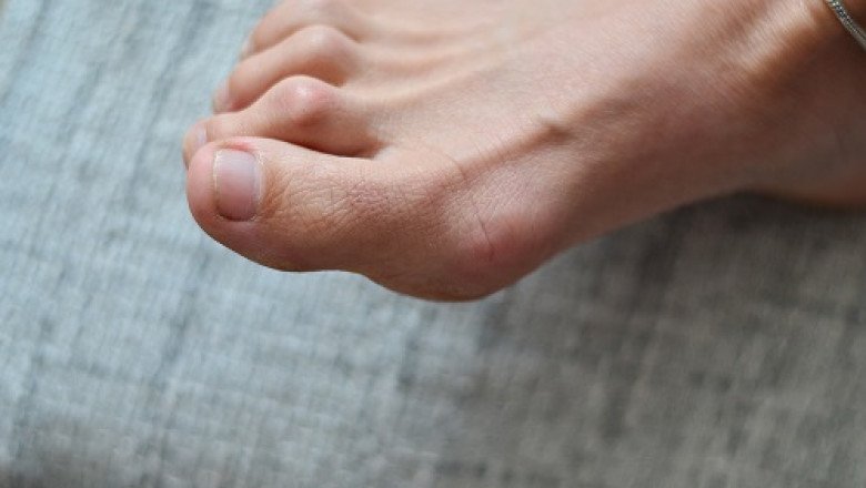 What are the best treatments to straighten painful hammertoes