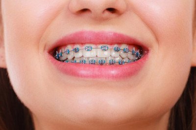 Global Dental Braces Market: Trends, Share, Size, Growth, Opportunity, and Forecasts