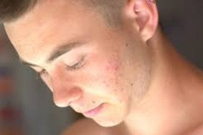 How To Use Retin-A Cream ?