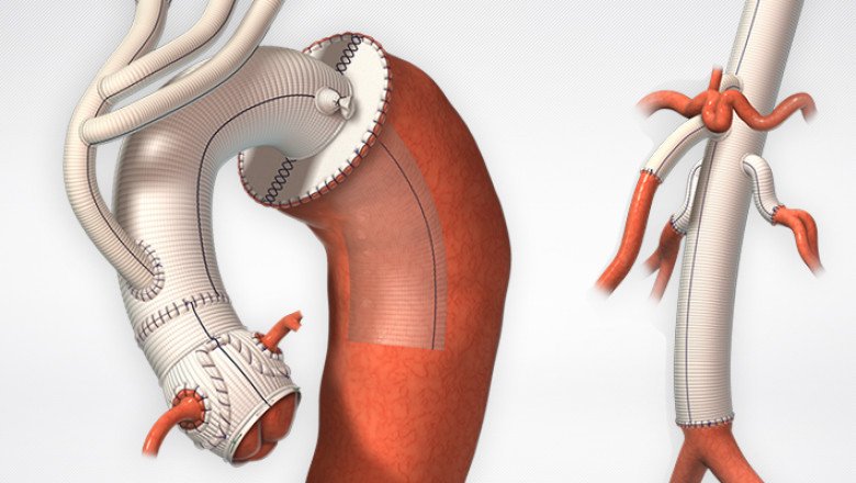 All You Need To Know About Tissue-Engineered Vascular Grafts