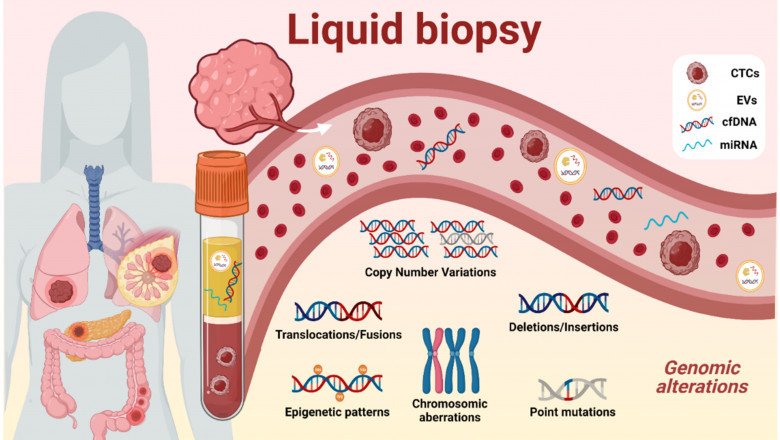 Patient Routine Health Care Has Been Transformed By Liquid Biopsy (LB) For Patients With Lung Cancer