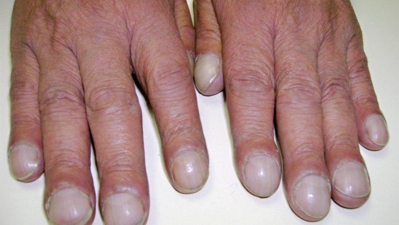 Eisenmenger Syndrome Treatment Embraces Regular Check-Ups And Monitoring To Manage The Condition And Prevent Complications
