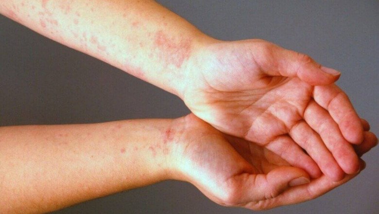 Depending On The Type Of Vasculitis And The Affected Areas/Organs, Vasculitis Treatment Varies