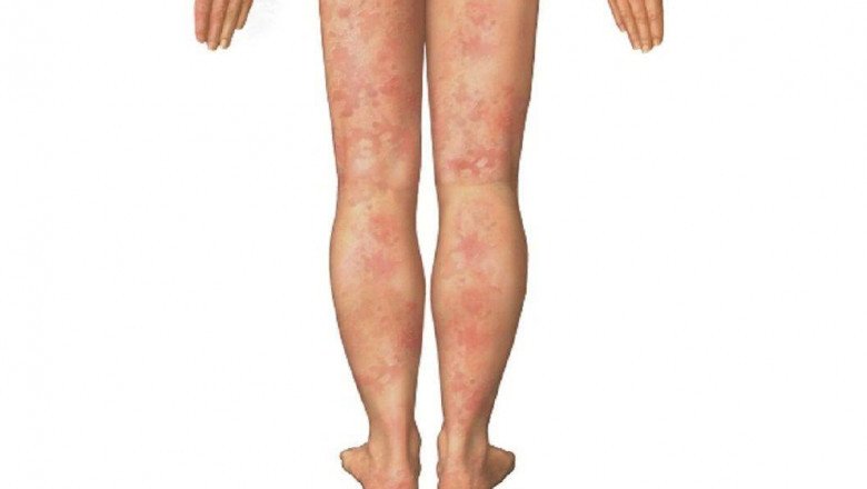 The Basic Goals Of Vasculitis Treatment Are To Reduce Inflammation And Address Any Underlying Conditions That May Be Causing It