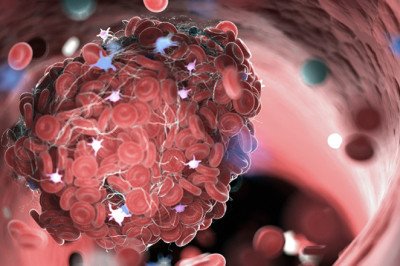Venous Thromboembolism (VTE)- When A Blood Clot Forms In Your Veins, It Blocks The Flow Of Blood
