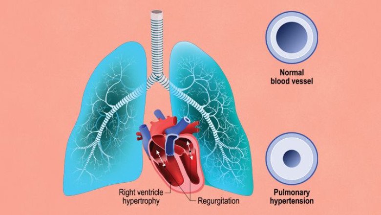 The Lungs Are Also Relaxed By Pulmonary Arterial Hypertension Drugs That Lower Blood Pressure In The Lungs