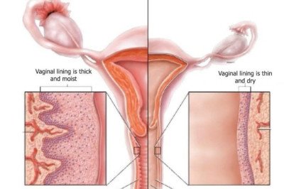 There Are Several Options Available For Atrophic Vaginitis Treatment, But Topical Estrogen Therapy Is The Most Commonly Prescribed