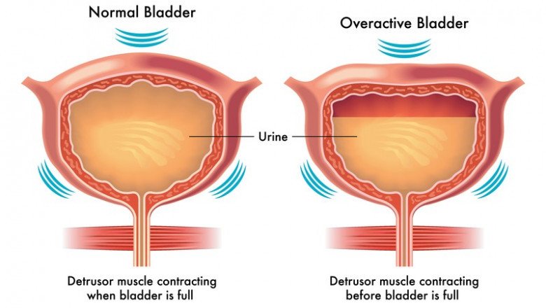 Overactive Bladder Treatment Market Insights, Analysis and Forecast during 2022-2028