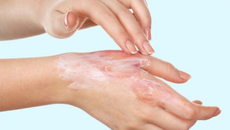 Burn Care Market Expansion, Growth Analysis and Forecast during 2019-2026