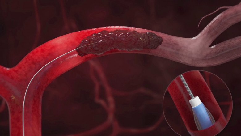 Global Thrombectomy Devices Market : Share, Size, Growth, Opportunity, and Forecast 2020-2027