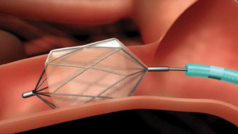Global Transcatheter Embolization and Occlusion Devices Market : Share, Size, Growth, Opportunity, and Forecast 2022-2028