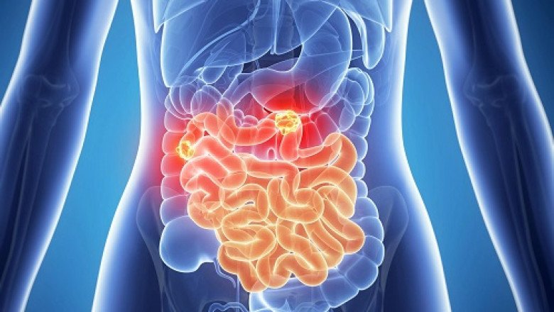 Treatments Stomach Cancer Drugs; drugs that are used to cure the disease
