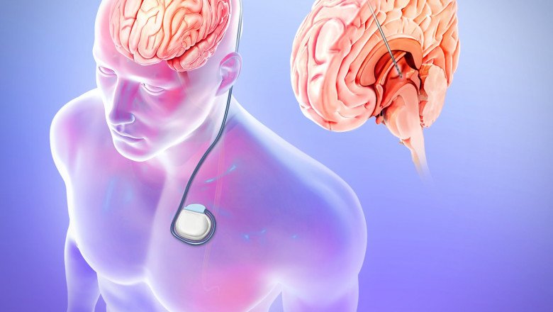 Vagus Nerve Stimulators are used to treat epilepsy and depression