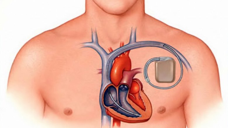 A Cardiac Pacemaker for the heart helps prevent slow heartbeats