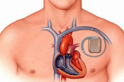 A Cardiac Pacemaker for the heart helps prevent slow heartbeats