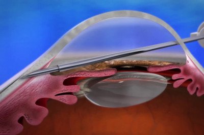 A study of the global Gel Stent Market : trends, market size, growth, opportunity, as well as forecasts for 2022-2028
