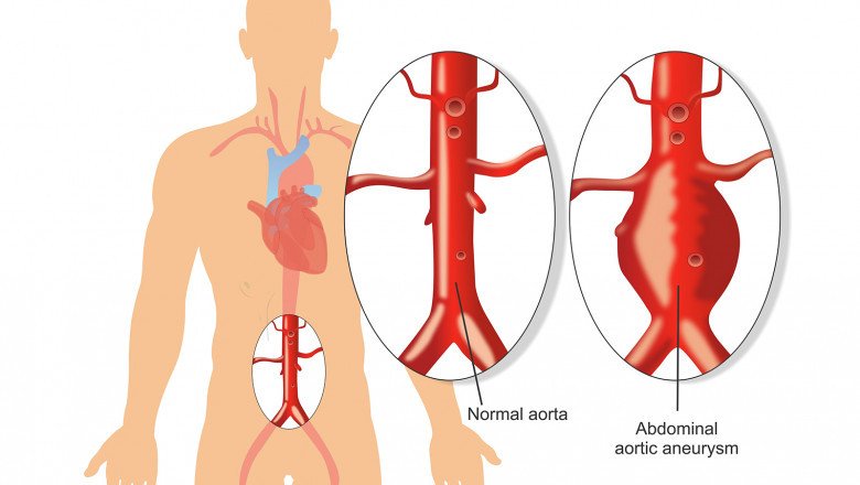 Abdominal Aortic Aneurysm Repair Devices Market Geographical Analysis and Insights during the Forecast Period 2022-2028