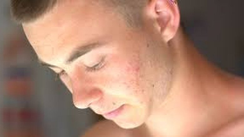 How To Use Retin-A Cream ?