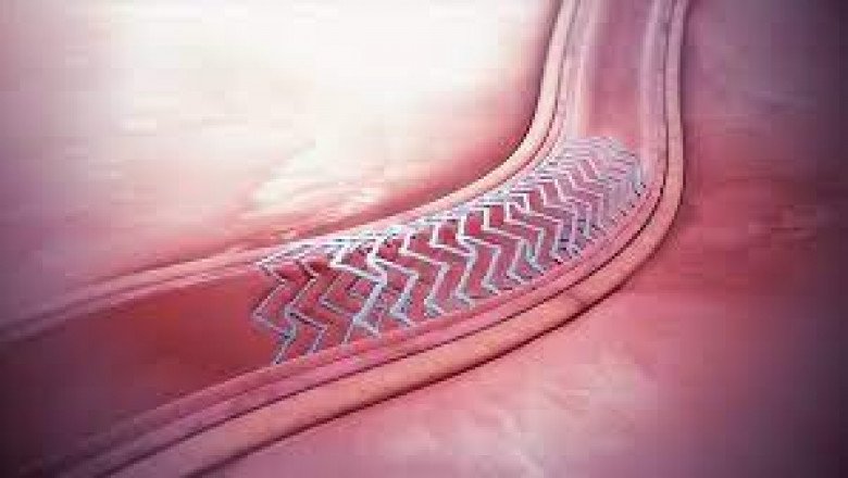 It is possible to restore the natural function of a vascular system with the use of biodegradable stents.