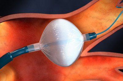 How Clinical Trials are used in Tumor Ablation Market?