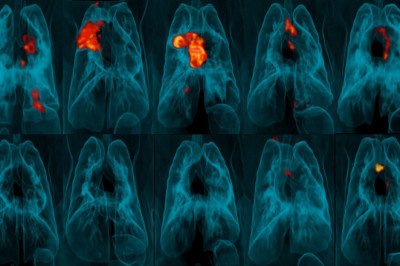 When Tuberculosis (TB) Is Prevalent Or At Risk, A Human Tuberculosis Vaccine Prevents It