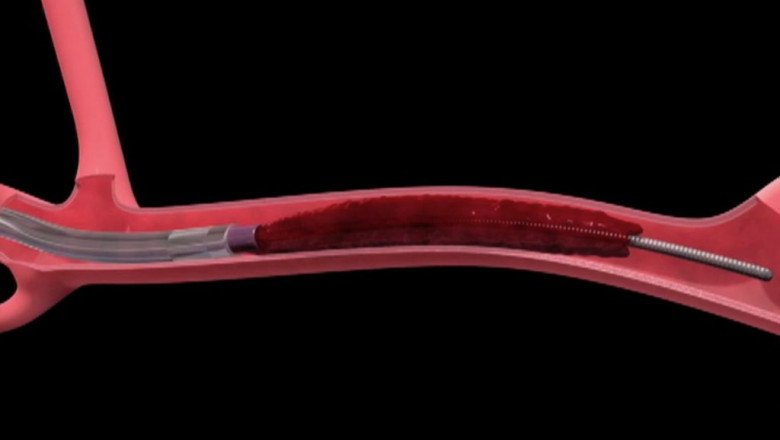 In the medical device industry, Thrombectomy Devices are advancing with increasing technological developments