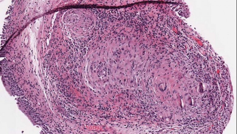 With the growing popularity of whole slide imaging, good analysis and management of these images are becoming increasingly important