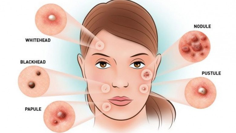 Acne Vulgaris Treatment Stops Pimples, Acne Growth, And Decreases Inflammation