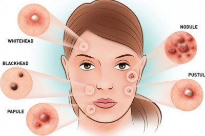 Acne Vulgaris Treatment Stops Pimples, Acne Growth, And Decreases Inflammation