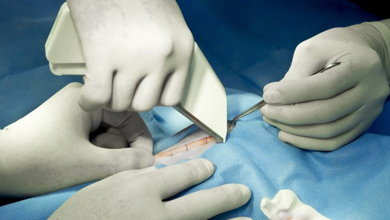 Let’s Know About the Evolution of Surgical Staplers