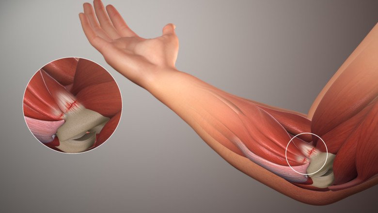 Global Soft Tissue Repair Market : Trends, Size, Growth, Opportunity, and Forecast to 2020-2027