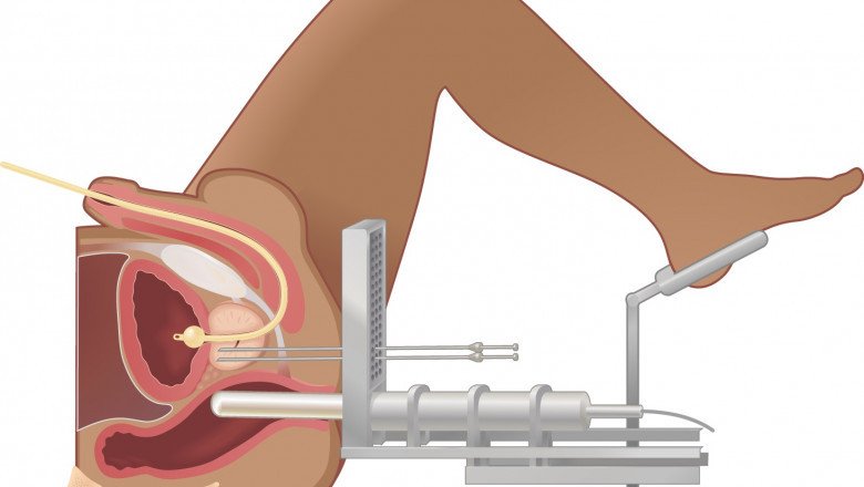 What does Happens in Brachytherapy?