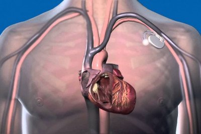 A cardiac pacemaker is used to treat a variety of heart-related conditions, such as bradycardia, atrial fibrillation, and slow heartbeats
