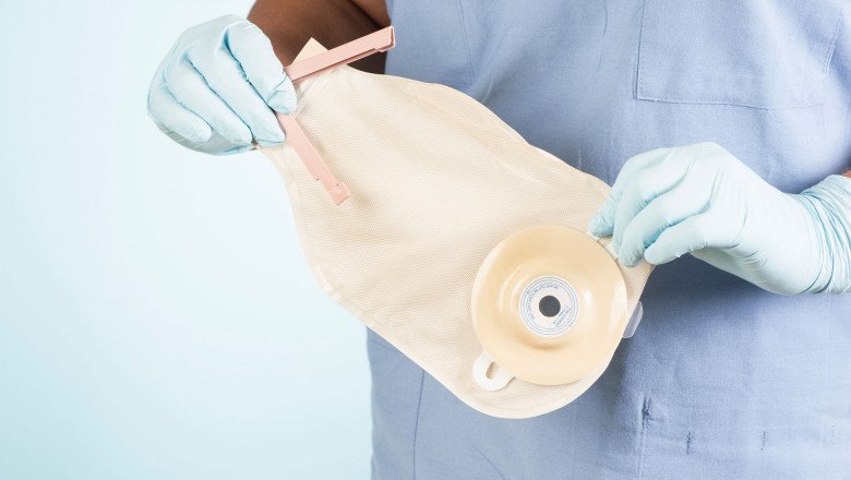 After a surgical procedure, ostomy care helps patients recover and transition to a normal lifestyle