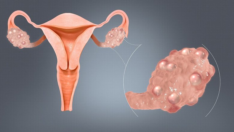 How to Cure Your PCOS