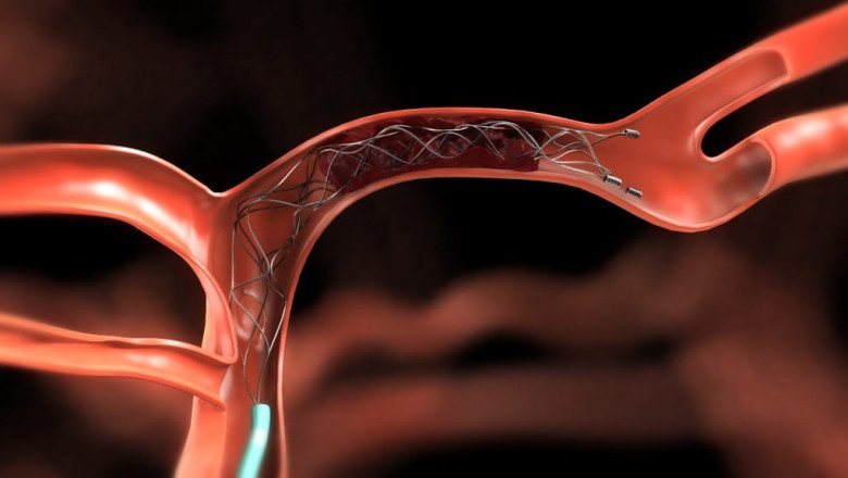 The Thrombectomy Devices Market Is Witnessing High Growth