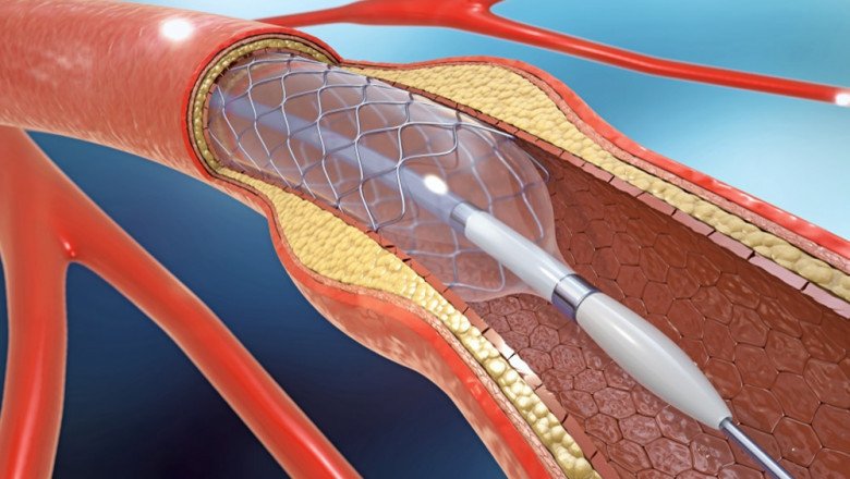 A Vascular Graft Is An Artificial Device Used In Surgery To Restore Blood Flow To The Body
