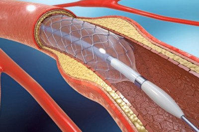A Vascular Graft Is An Artificial Device Used In Surgery To Restore Blood Flow To The Body
