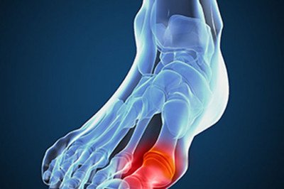 In Order To Effectively Treat And Manage Gouty Arthritis, Medical Care And Self-Management Techniques Should Be Used