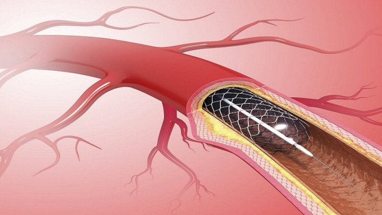 Coronary Stents are expandable metal meshes that have improved percutaneous coronary revascularization outcomes