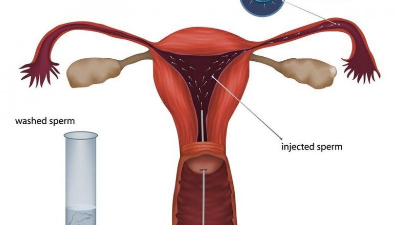 Let’s Know the Process of Intrauterine Insemination (IUI) in Artificial Insemination