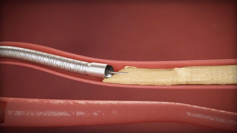 Atherectomy Devices Market Proliferating Opportunities, New Innovation, Development, Application Till 2027