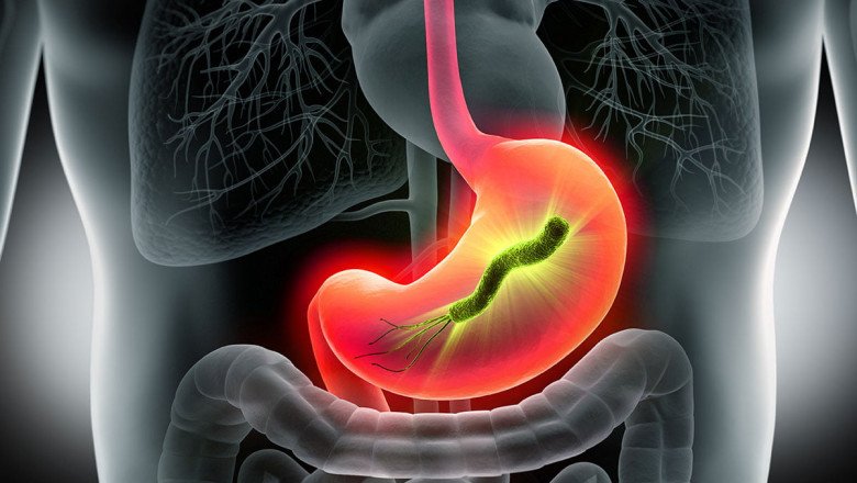 Gastritis Treatment Market Competitive Insights and Precise Outlook 2022-2028