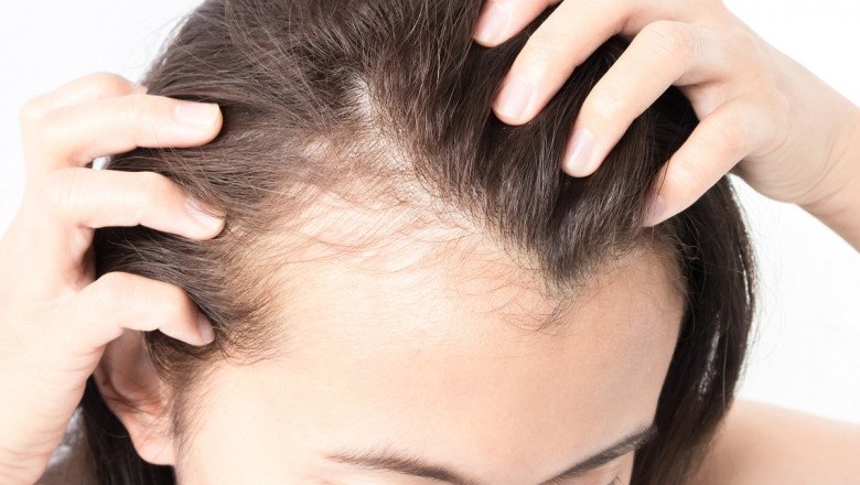 Hair Loss Treatment Market : Global Industry Trends, Share, Size, Growth, Opportunity and Forecast 2022-2028