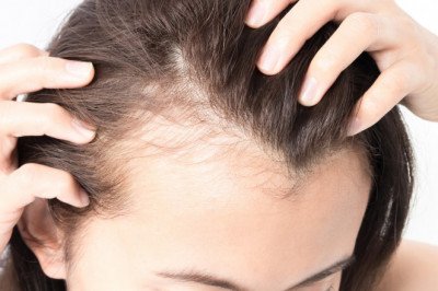 Hair Loss Treatment Market : Global Industry Trends, Share, Size, Growth, Opportunity and Forecast 2022-2028