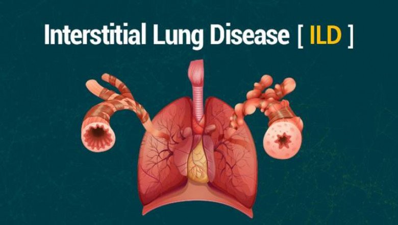 Interstitial Lung Disease Market : Global Industry Trends, Share, Size, Growth, Opportunity and Forecast 2022-2028