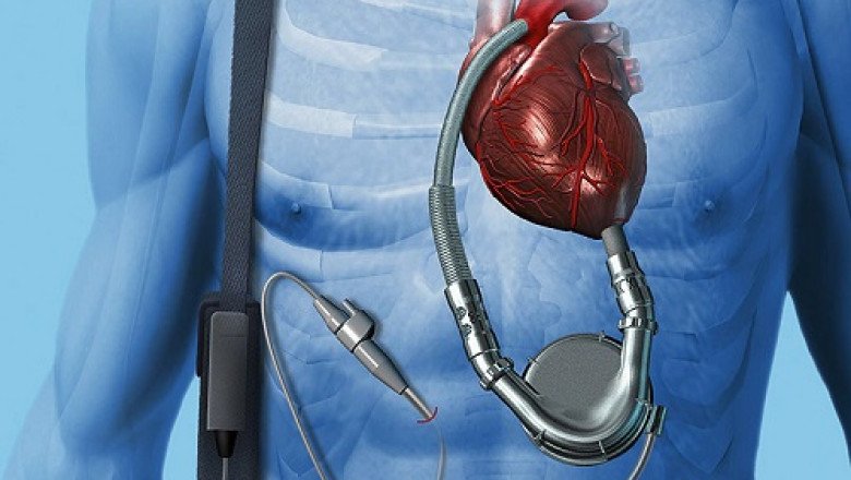 Pumps blood from the lower chambers of the heart with the help of Ventricular Assist Devices