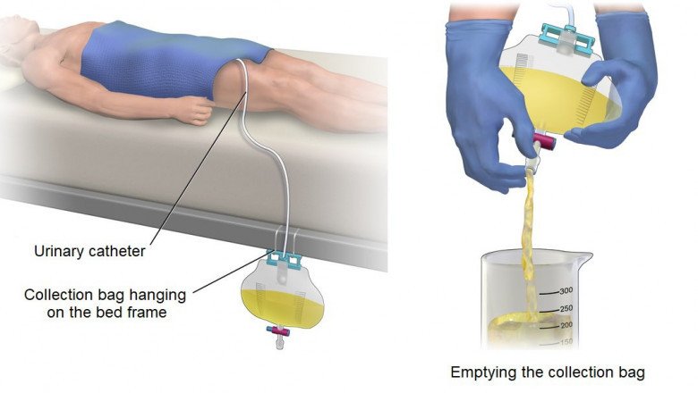 Urinary Catheters Market Upcoming Trends, Demand, Regional Analysis and Forecast 2030