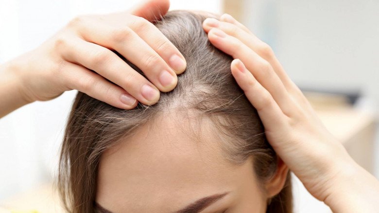 Alopecia Treatment Market Outlook, Segmentations and Forecast Analysis by 2028
