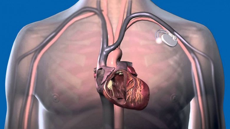 Implantable Cardiac Pacemaker are medical devices used to regulate the heart's function